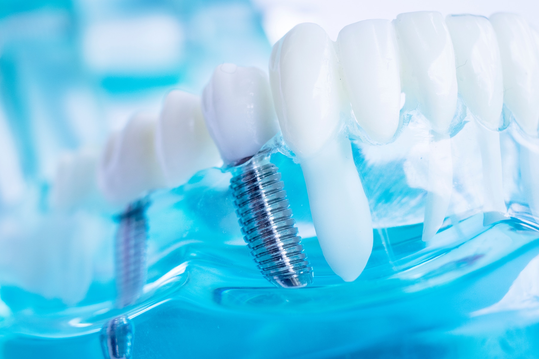 Dental implant procedure in Battle Creek, MI